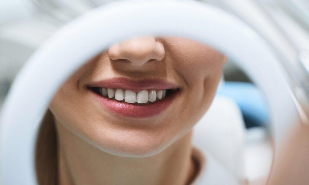 Pourquoi l’éclaircissement dentaire est le gradient thérapeutique le moins invasif