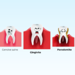 Maladies parodontales, comparaison gingivite et la parodontite
