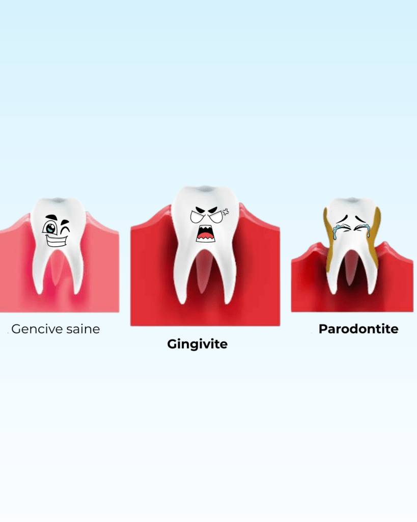 Maladies parodontales, comparaison gingivite et la parodontite