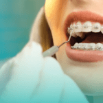 un dentiste qui mets un appareil dentaire a un patient pour aligner ses dents