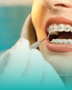 un dentiste qui mets un appareil dentaire a un patient pour aligner ses dents
