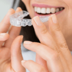 pose d'appareil dentaire invisible