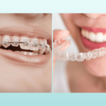 comparaison bague et aligneurs invisibles