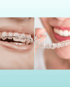 comparaison bague et aligneurs invisibles