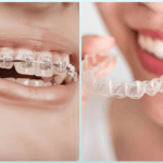 Comparaison bague et aligneurs invisibles.