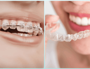 Comparaison bague et aligneurs invisibles.