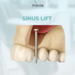 Sinus lift : schéma d’élévation du sinus maxillaire avec création d’un espace pour greffe osseuse avant implant dentaire.