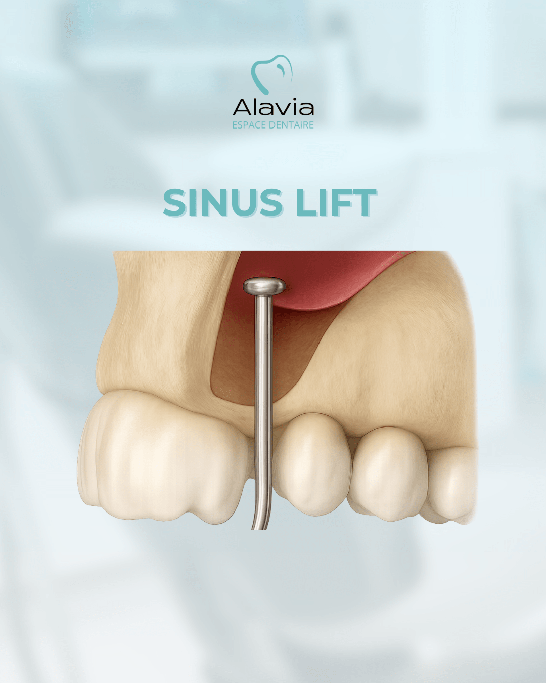 Sinus lift : schéma d’élévation du sinus maxillaire avec création d’un espace pour greffe osseuse avant implant dentaire.