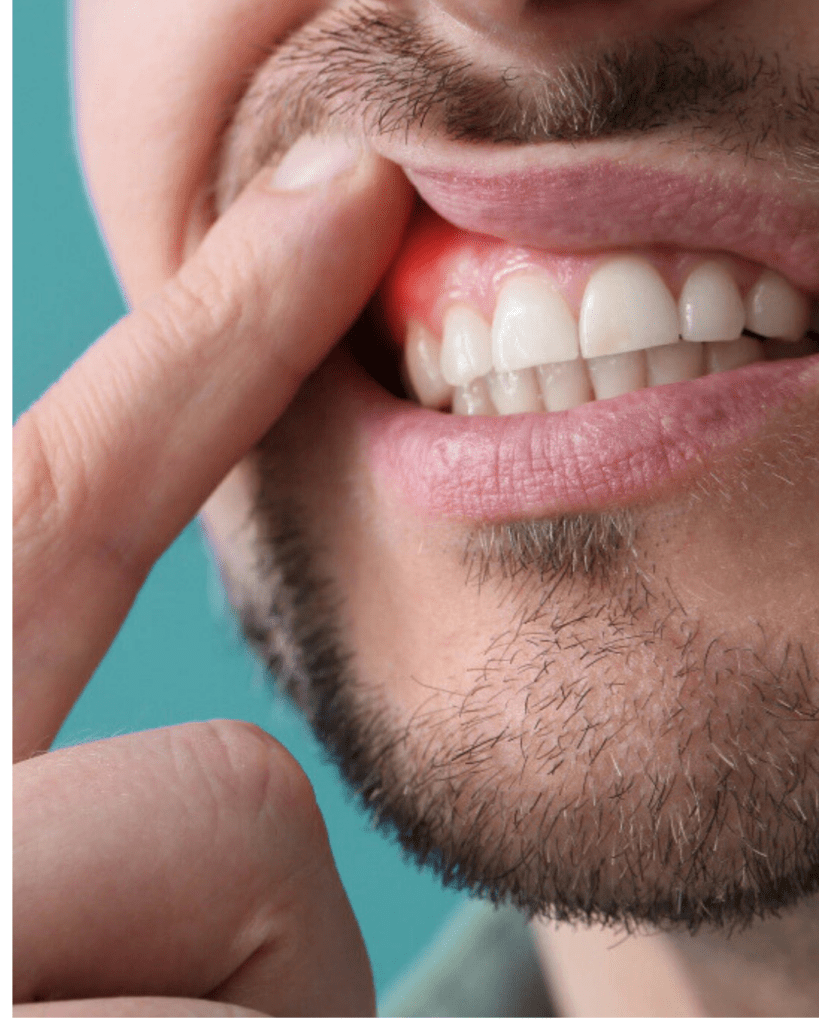 Gencive atteint d'une maladie parodontale