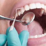 soins parodontales