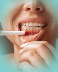 Gencive inflammé, maladie parodontale