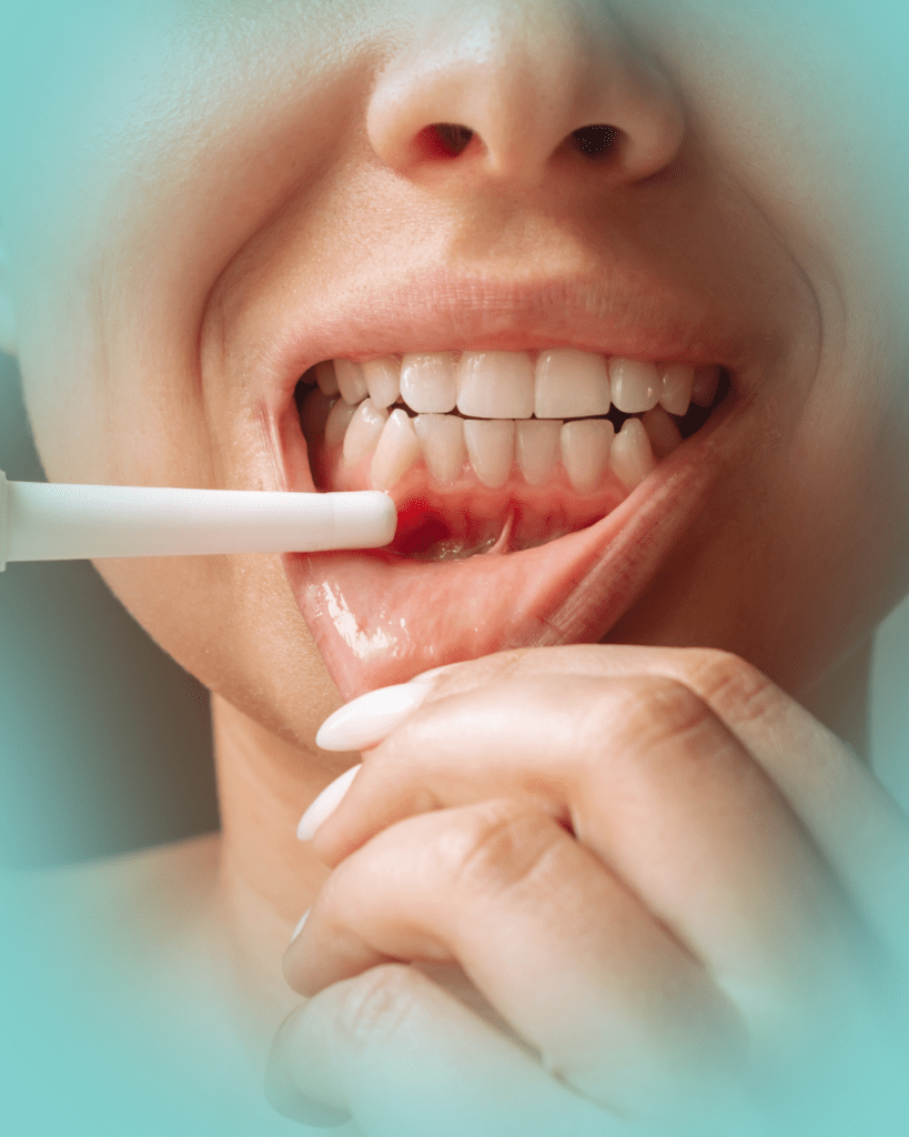 Gencive inflammé, maladie parodontale