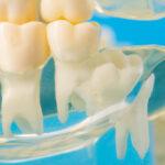 Modèle de mâchoire dentaire médicale avec des dents de sagesse visibles.