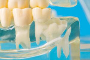 Modèle de mâchoire dentaire médicale avec des dents de sagesse visibles.