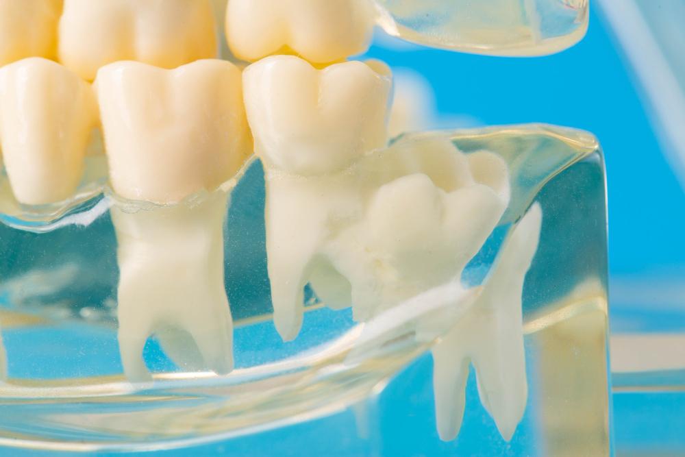 Modèle de mâchoire dentaire médicale avec des dents de sagesse visibles.